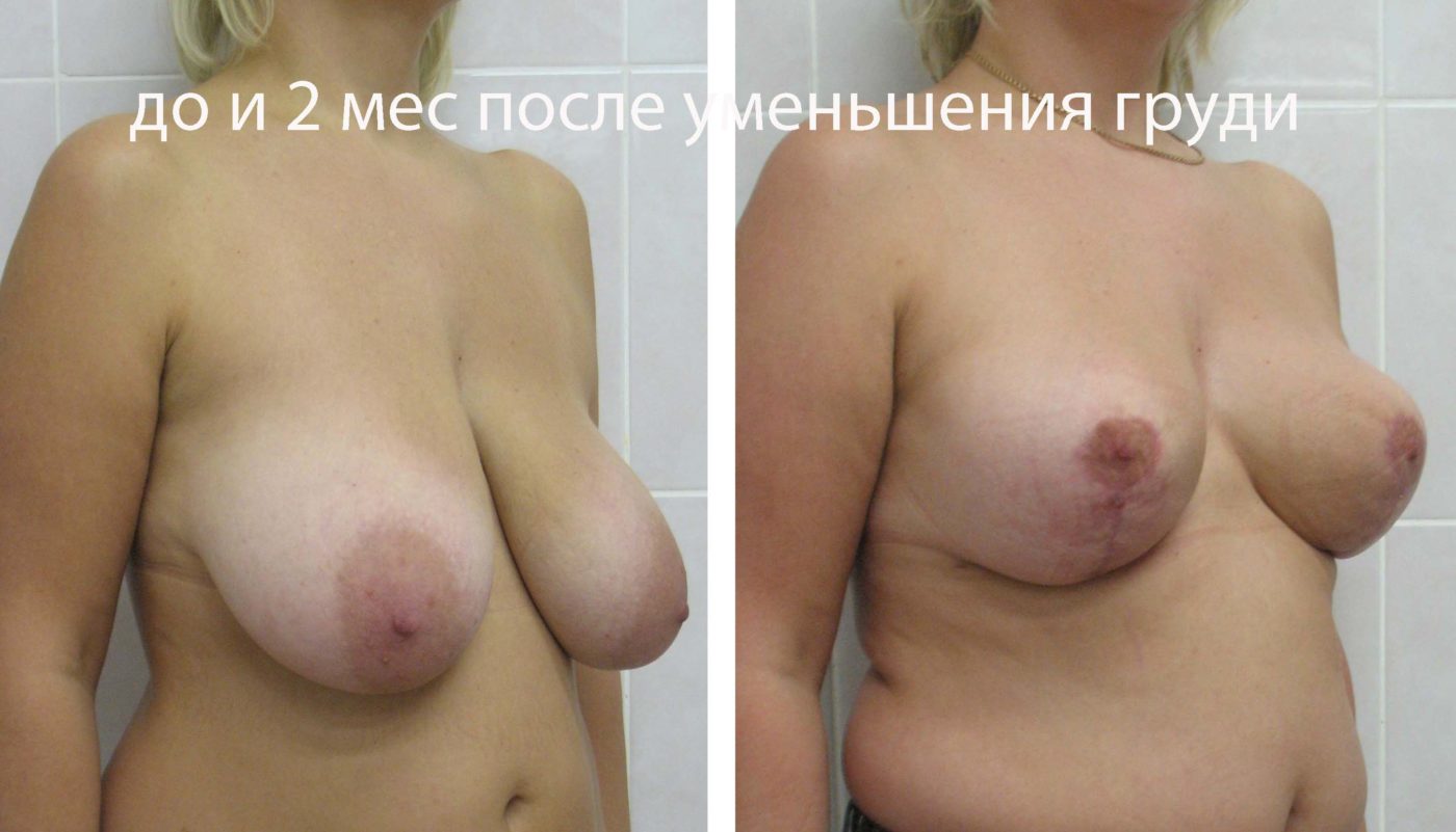 уменьшение размера груди операцией фото 99