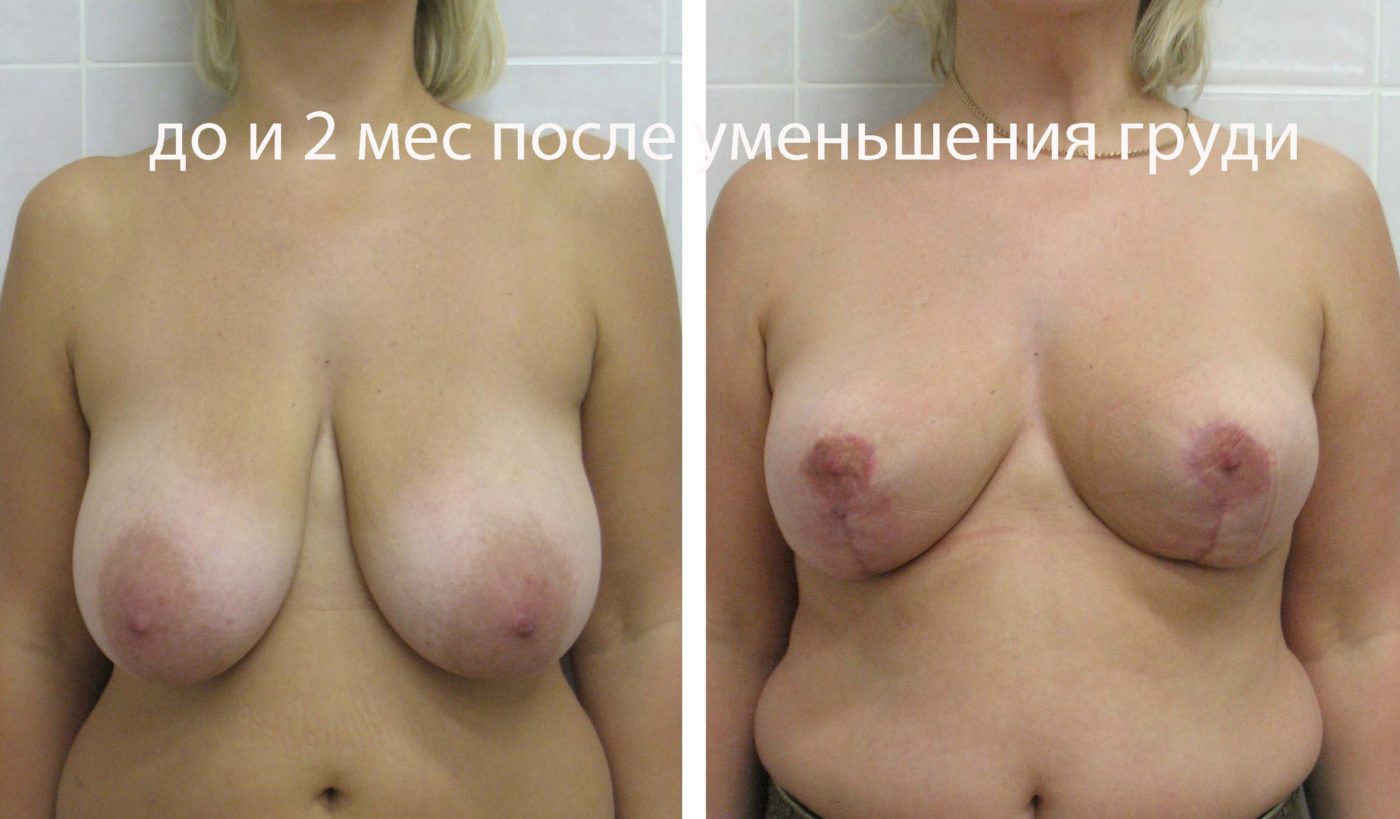 операция по уменьшения размера груди фото 19