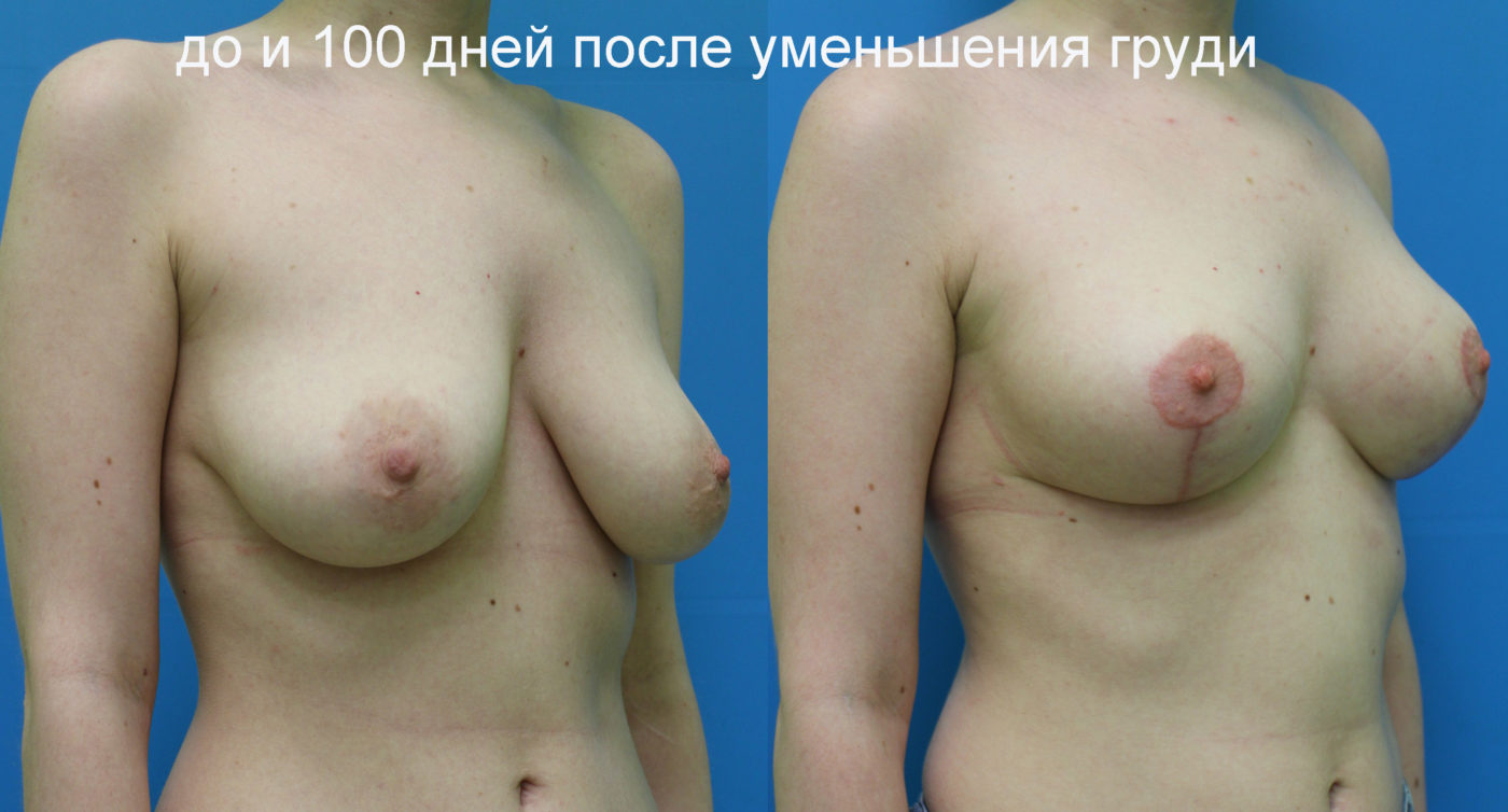 операция по уменьшения размера груди фото 85