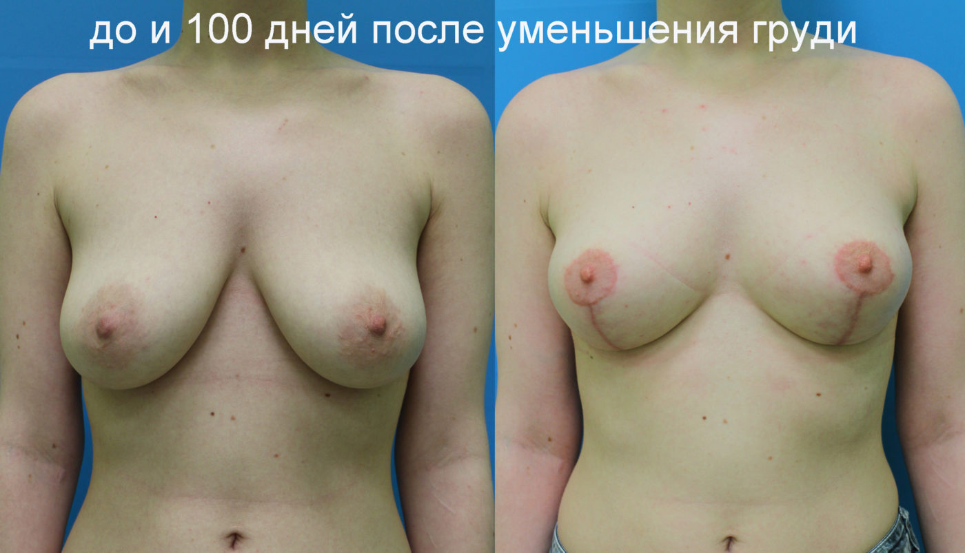уменьшение размера груди операцией фото 91