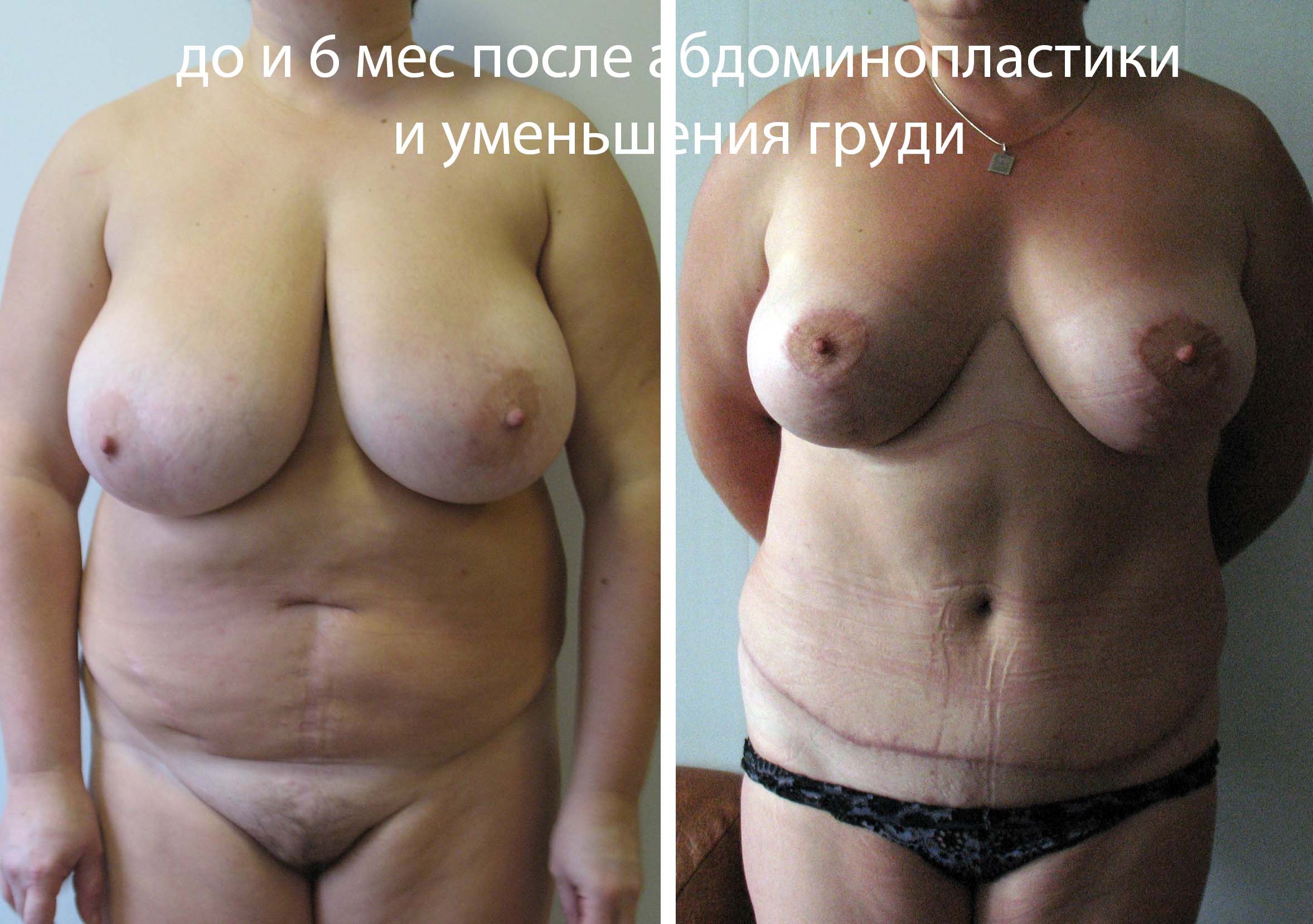 операция по уменьшения размера груди фото 71