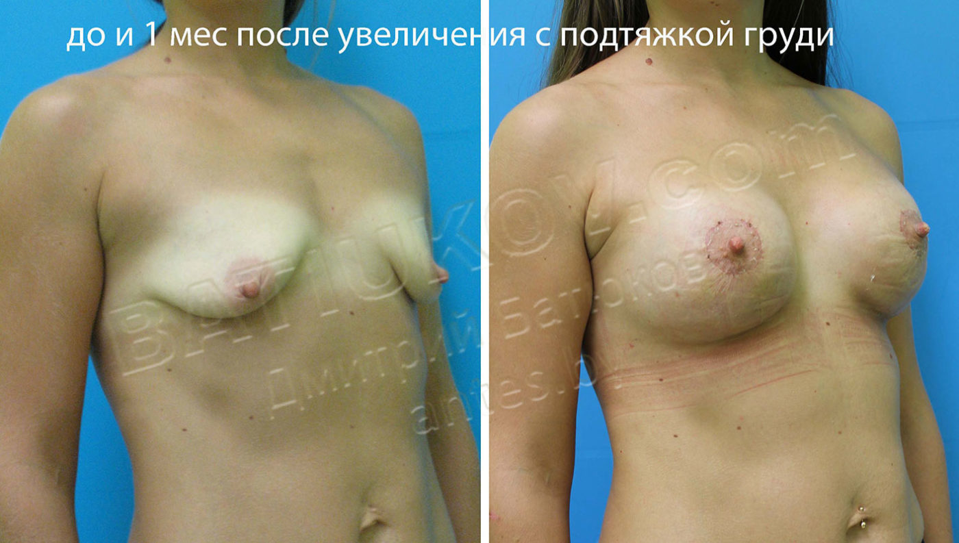 тубулярная деформация груди у женщин фото 6