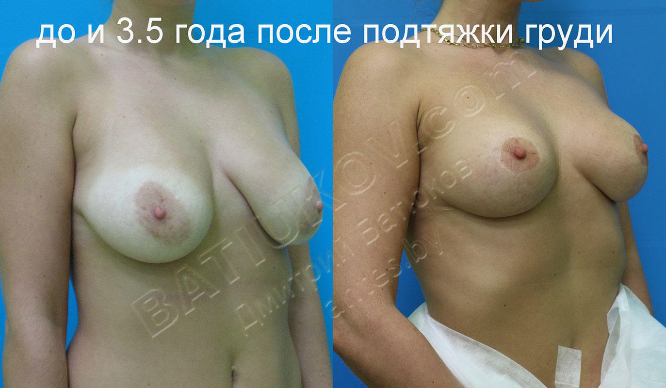 операция по подтяжке груди у женщин фото 72